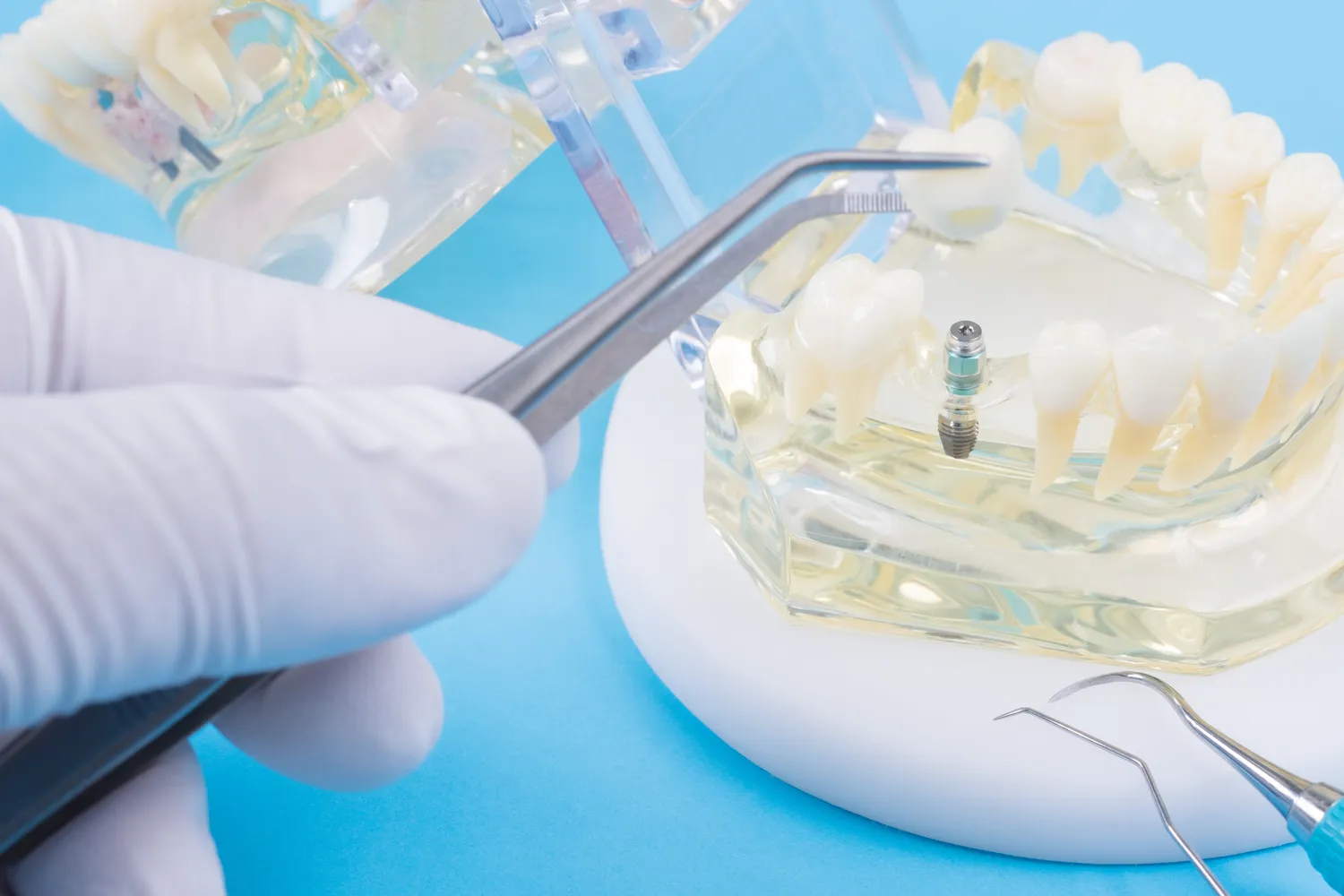 Klinika implantologii Warszawa