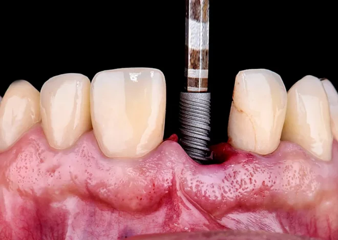 Implanty zębów cała szczęka cena Szczecin