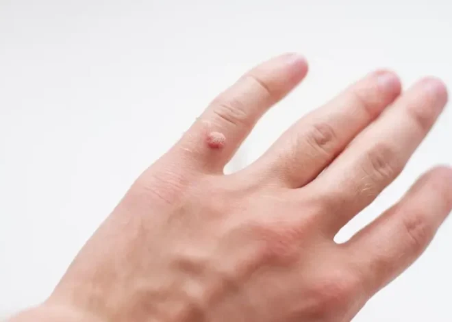 Jak domowym sposobem usunąć kurzajki?