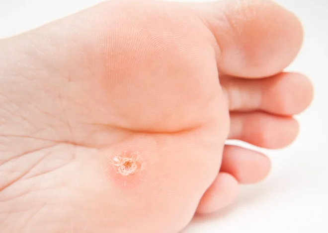 Jak wygląda rdzeń kurzajki?