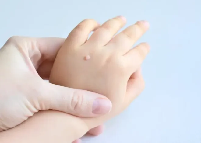 Od czego powstają kurzajki na dłoniach